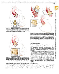 Valvular Heart Disease: A Companion to Braunwald's Heart Disease
